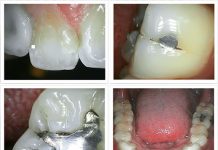 Intraoral kamera